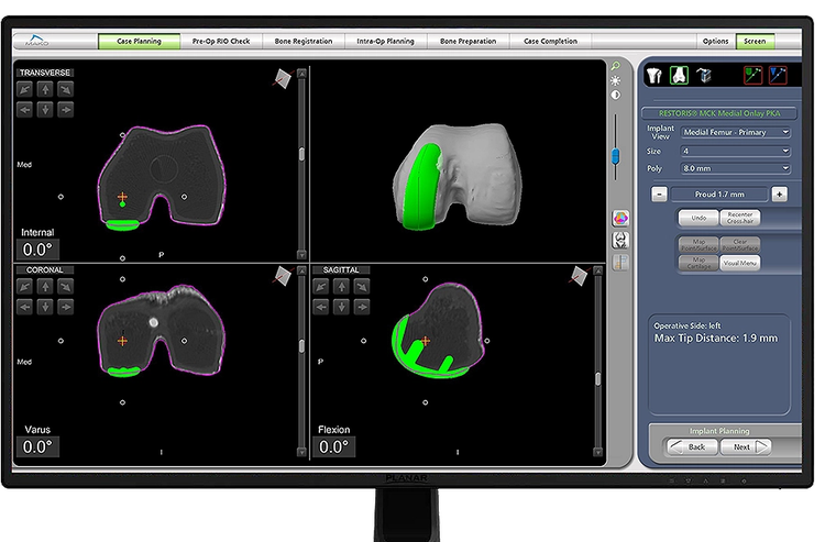 Source: Stryker website, Mako system partial knee replacement. 